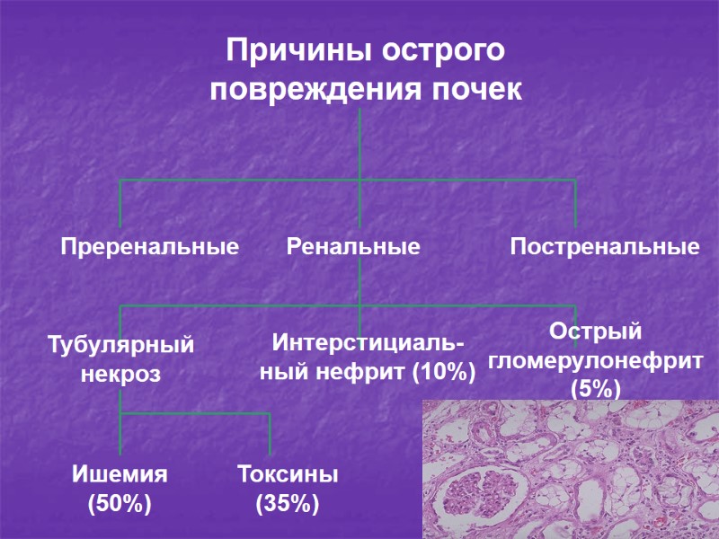 Причины острого повреждения почек Преренальные Ренальные Постренальные Тубулярный некроз Интерстициаль-ный нефрит (10%) Острый 